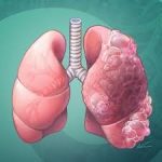 COPD TITLE IMAGE