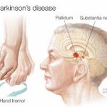 Parkinson image - panrum