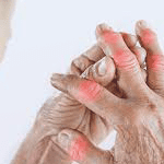 Rheumatoid Arthritis-title