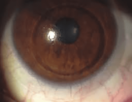 cataracts-new-2023-imagev13