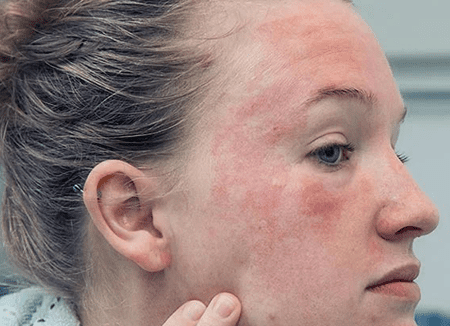 Eczema - new 2023 -imagev10