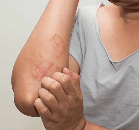 Eczema - new 2023 -imagev2