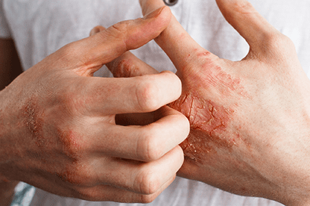 Eczema - new 2023 -imagev7