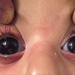 glaucoma-new-2023-imagev3