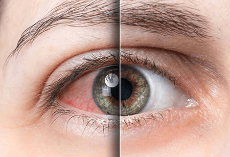 glaucoma - new 2023 -imagev5