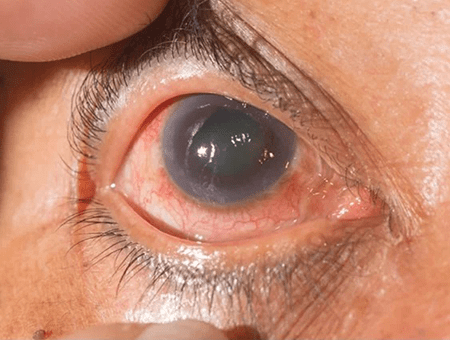 glaucoma - new 2023 -imagev6