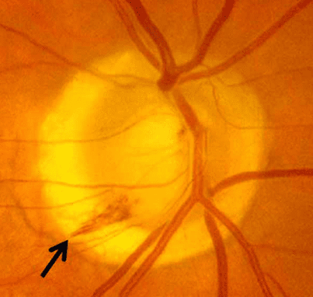 glaucoma - new 2023 -imagev8